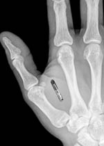 microchip implants